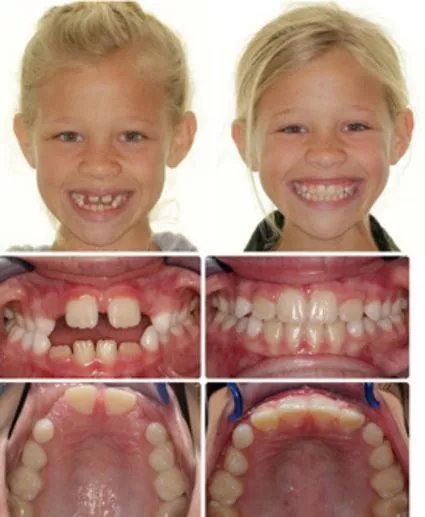 Enhancing Smiles: Before And After Palate Expander Guide